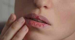 تعرف على العلاجات المنزلية لتخفيف جفاف الفم