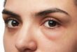 ما لا تعرفه عن الأكياس تحت العين من الأسباب للعلاج