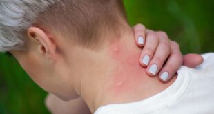 مرض الملاريا.. تعرف على الأعراض والتشخيص والعلاج والوقاية