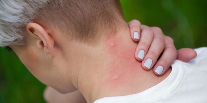 مرض الملاريا.. تعرف على الأعراض والتشخيص والعلاج والوقاية