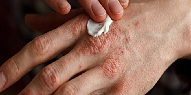 هل يمكن أن يؤدي ضعف الصحة العقلية لمشاكل جلدية؟.. اعرف طرق الوقاية