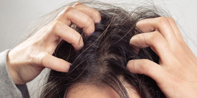 وصفات طبيعية للتخلص من قشرة الرأس.. خطوات سهلة ومكونات متوفرة