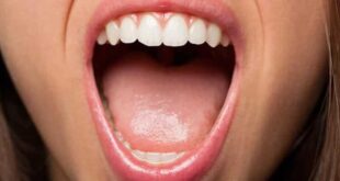 أسباب متعددة لفرط اللعاب؟- هكذا يمكنك التحكم فيه