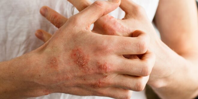 5 مشكلات جلدية شائعة وطرق علاجها.. الأكزيما وفرط التصبغ أبرزها