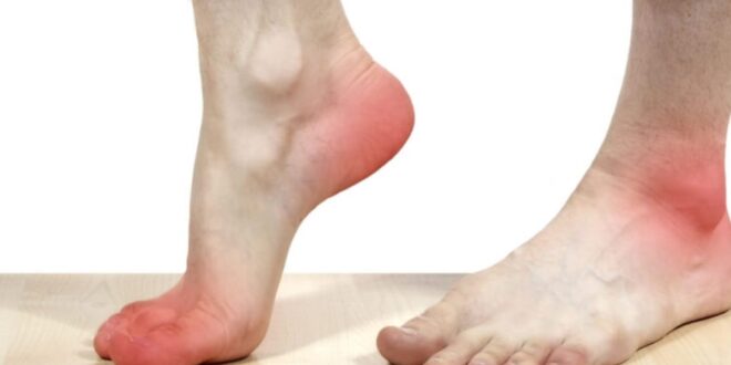 أسباب مختلفة لاحمرار القدمين عند الوقوف وطرق الوقاية منه