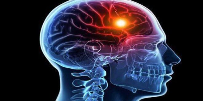 أعراض خطيرة- ماذا يحدث عند تمدد الأوعية الدموية الدماغية؟
