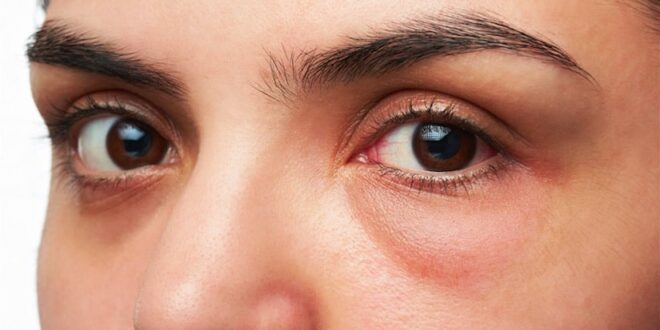 5 وصفات طبيعية سهلة وسريعة للتخلص من انتفاخ العينين