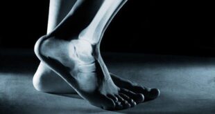 تجنبا للهشاشة - كيف تحافظ على سلامة عظام الجسم؟