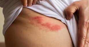 أعراض الحزام الناري وطرق علاجه