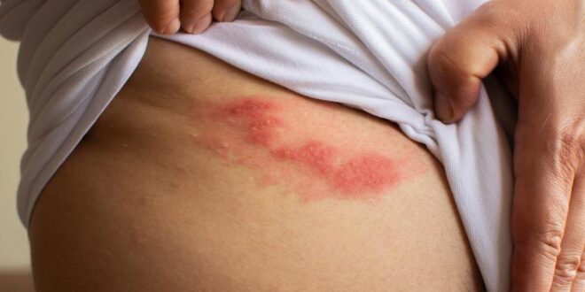 أعراض الحزام الناري وطرق علاجه