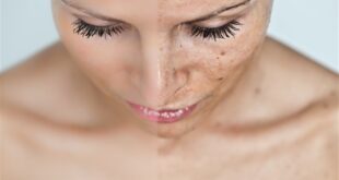 حيل علاجية تخلصك من بقع الجسم والكلف..