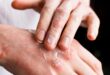طرق الوقاية من التهاب الجلد مع انخفاض درجات الحرارة