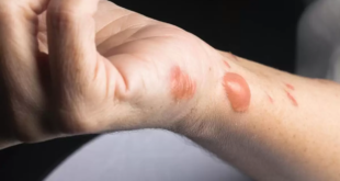 طرق طبيعية تساعد فى التخلص من الندبات وعلامات الحروق