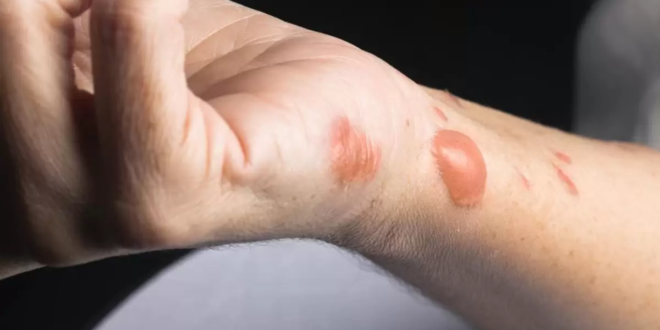 طرق طبيعية تساعد فى التخلص من الندبات وعلامات الحروق