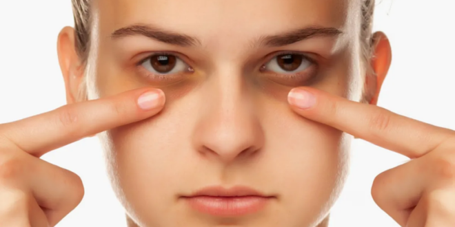 عادات وأمراض وراء الإصابة بالهالات السوداء