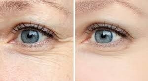 "تجاعيد حول العين: الأسباب وطرق الوقاية والعلاج"