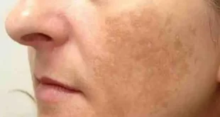أسباب الكلف وطرق علاجه الفعّالة