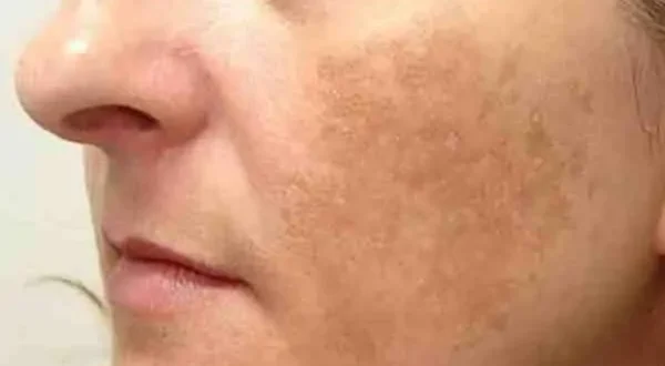 أسباب الكلف وطرق علاجه الفعّالة