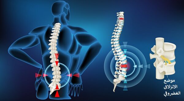 آلام الديسك: الأسباب، الأعراض، وطرق العلاج الفعّالة