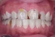 تسوس الأسنان: أسبابه وأعراضه وطرق الوقاية والعلاج