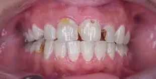 تسوس الأسنان: أسبابه وأعراضه وطرق الوقاية والعلاج
