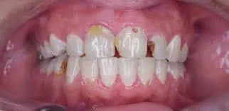 تسوس الأسنان: أسبابه وأعراضه وطرق الوقاية والعلاج