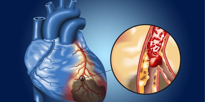 صحة الشرايين.. خط الدفاع الأول ضد أمراض القلب